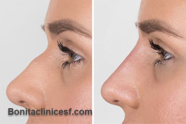 کلینیک زیبایی اصلاح فرم بینی در اصفهان | کلینیک بنیتا اصفهان