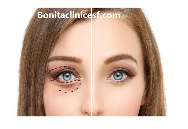 بهترین جراح بلفاروپلاستی در اصفهان - کلینک بنیتا اصفهان