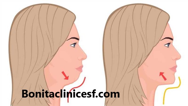 ساکشن غبغب | کلینیک بنیتا اصفهان