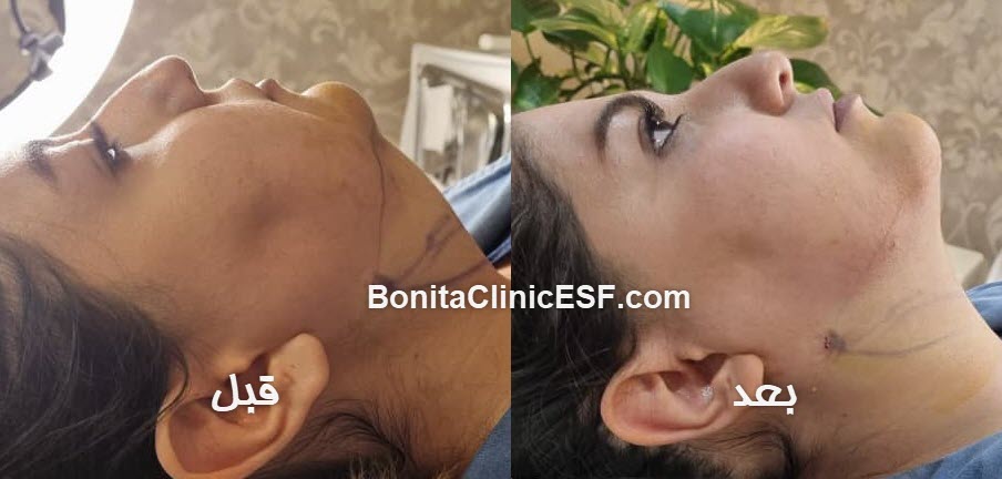 ساکشن غبغب و بوکال فت در اصفهان | کلینیک بنیتا