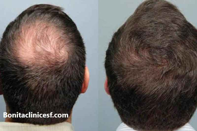 کاشت مو - کلینیک بنیتا