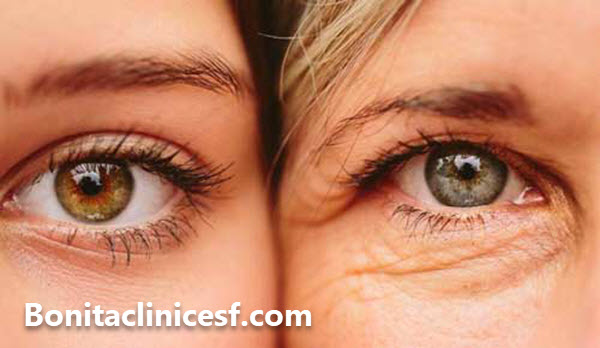 مرکز بلفاروپلاستی و رفع افتادگی پلک در اصفهان - کلینیک بنیتا