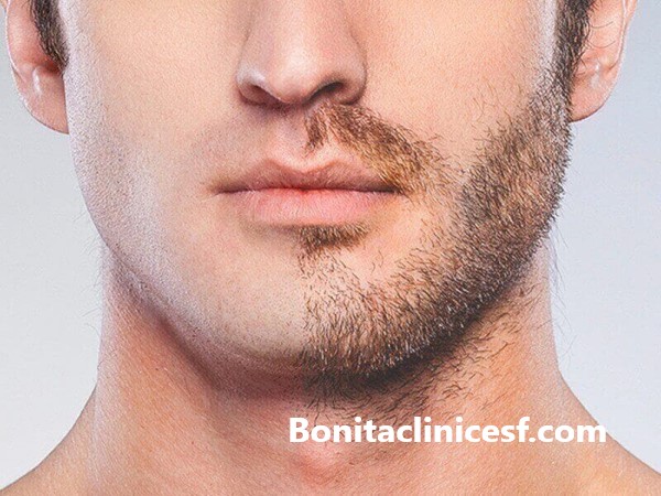 مرکز کاشت ریش در اصفهان - کلینیک بنیتا اصفهان