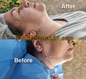 تخلیه و ساکشن غبغب در کلینیک بنیتا اصفهان