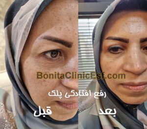 جراحی پلک و بلفاروپلاستی در اصفهان | کلینیک بنیتا