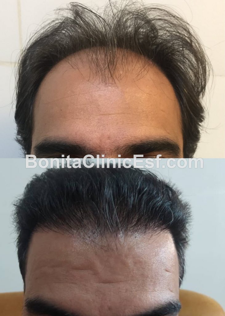 بهترین کلینیک کاشت مو در اصفهان | بنیتا