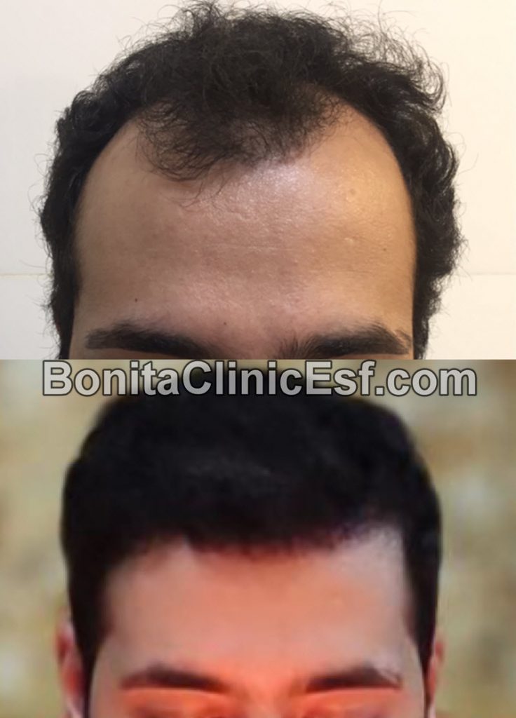 بهترین کلینیک کاشت مو در اصفهان | بنیتا