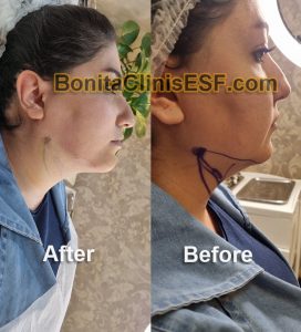 تخلیه و ساکشن غبغب در کلینیک بنیتا اصفهان