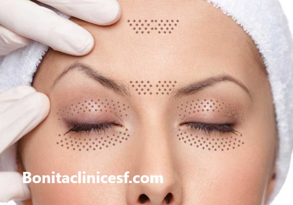 هزینه عمل افتادگی پلک در اصفهان - کلینیک بنیتا اصفهان