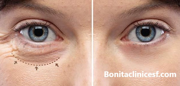 کلینیک همواره تخفیف جراحی پلک در اصفهان | کلینیک بنیتا اصفهان