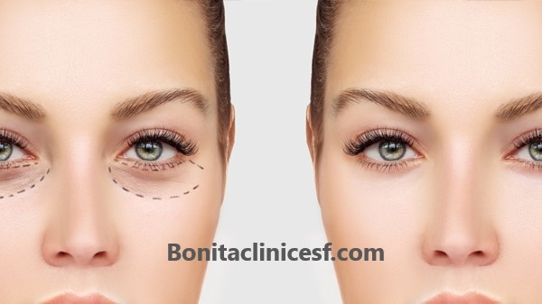 کلینیک همواره تخفیف جراحی پلک در اصفهان | کلینیک بنیتا اصفهان