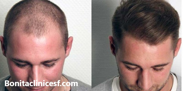 آشنایی با انواع روش های کاشت مو | کلینیک بنیتا اصفهان