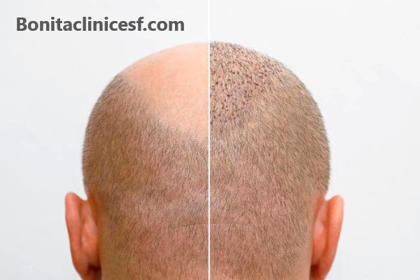 آشنایی با انواع روش های کاشت مو | کلینیک بنیتا اصفهان