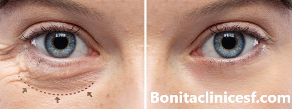 برترین کلینیک تخصصی بلفاروپلاستی در اصفهان - کلینیک بنیتا