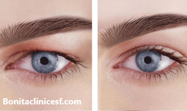 برترین کلینیک تخصصی بلفاروپلاستی در اصفهان - کلینیک بنیتا