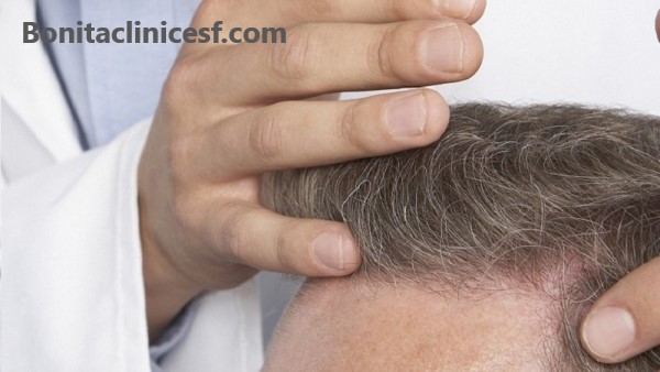 بهترین روش کاشت مو با تراکم بالا | کلینیک بنیتا اصفهان