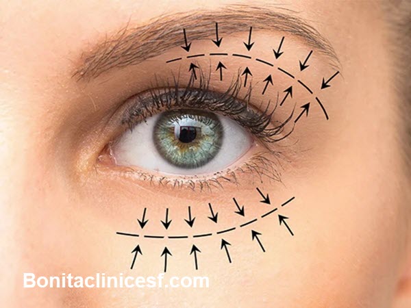 بهترین مرکز بلفاروپلاستی در اصفهان - کلینیک بنیتا