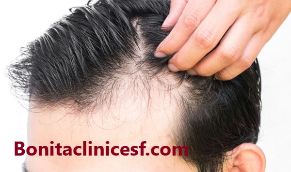 بهترین کلینیک کاشت مو در اصفهان - کلینیک بنیتا اصفهان