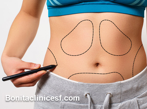 عمل ابدومینوپلاستی چیست؟ - کلینیک بنیتا اصفهان