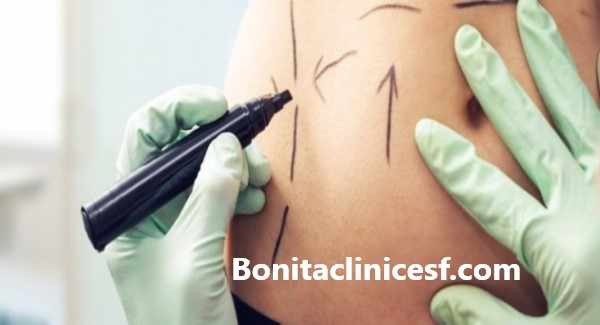 هزینه عمل لیپوساکشن در اصفهان چقدر است؟ - کلینیک بنیتا اصفهان