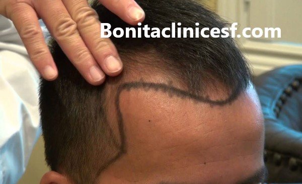 هزینه کاشت موی سر چقدر است؟ - کلینیک بنیتا اصفهان
