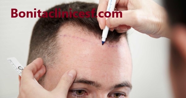 هزینه کاشت مو در اصفهان چقدر است؟ - کلینیک بنیتا اصفهان