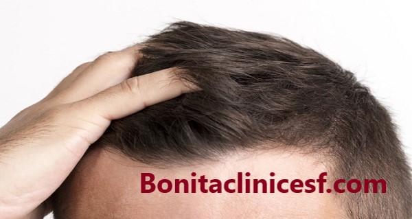 هزینه کاشت مو در اصفهان چقدر است؟ - کلینیک بنیتا اصفهان