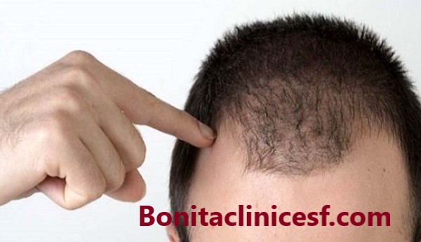 بهترین کلینیک کاشت مو در اصفهان - کلینیک بنیتا اصفهان