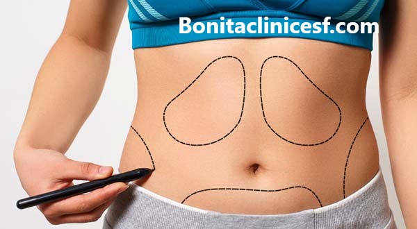 هزینه عمل لیپوساکشن در اصفهان چقدر است؟ - کلینیک بنیتا اصفهان