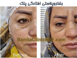 بلفاروپلاستی پلک بالا در اصفهان | کلینیک بنیتا