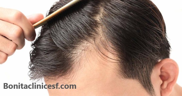 بهترین روش کاشت مو با تراکم بالا | کلینیک بنیتا اصفهان