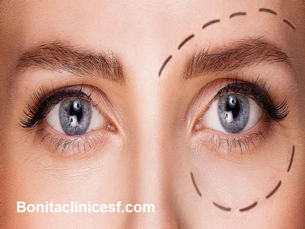 بهترین مرکز بلفاروپلاستی در اصفهان - کلینیک بنیتا