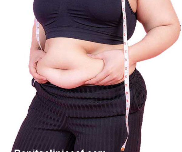 عمل ابدومینوپلاستی چیست؟ - کلینیک بنیتا اصفهان