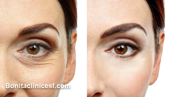 بهترین کلینیک بلفاروپلاستی در اصفهان - کلینیک بنیتا