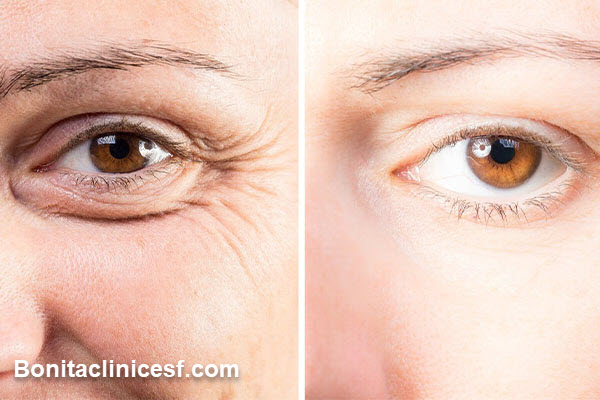 بهترین کلینیک بلفاروپلاستی در اصفهان - کلینیک بنیتا