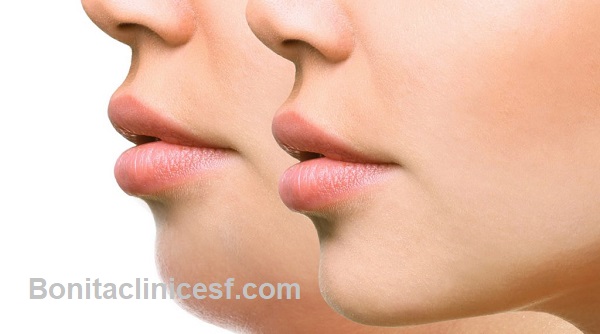 ماندگاری تزریق ژل چقدر است؟ - کلینیک بنیتا اصفهان