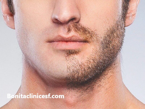 هزینه کاشت ریش و سبیل چقدر است؟ | کلینیک بنیتا اصفهان