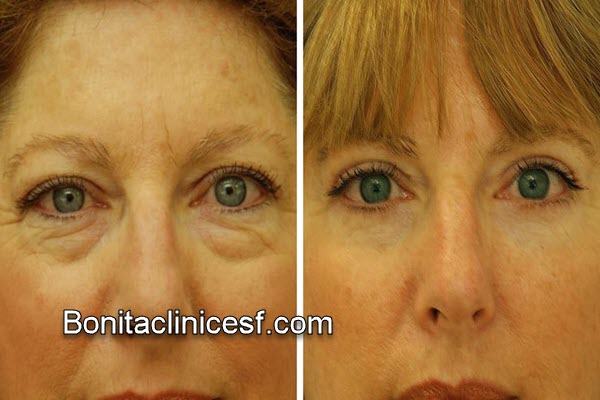 مرکز تخصصی جراحی پف زیر چشم در اصفهان | کلینیک بنیتا اصفهان