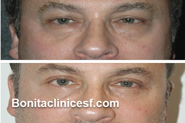 هزینه عمل بلفاروپلاستی در شهر اصفهان | کلینیک بنیتا اصفهان