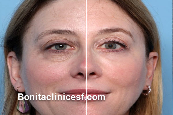 هزینه عمل بلفاروپلاستی در شهر اصفهان | کلینیک بنیتا اصفهان