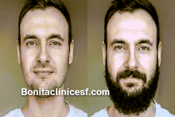 هزینه کاشت ریش چقدر است | کلینیک بنیتا اصفهان