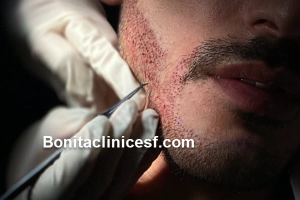 هزینه کاشت ریش چقدر است | کلینیک بنیتا اصفهان