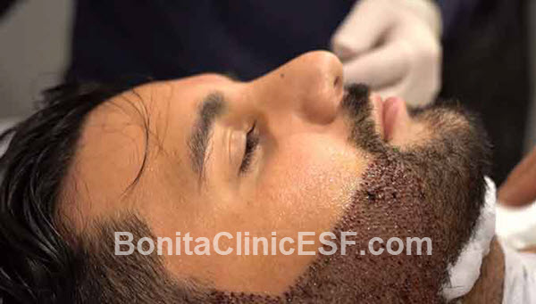 بهترین متخصص کاشت ریش در اصفهان | کلینیک بنیتا