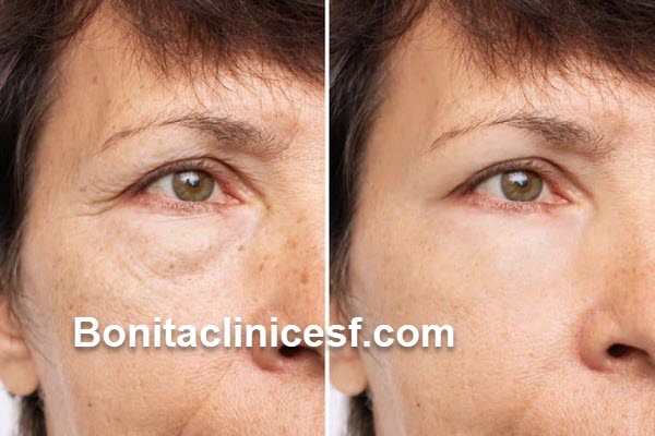 هزینه عمل بلفاروپلاستی در شهر اصفهان | کلینیک بنیتا