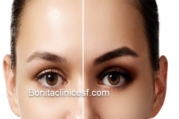 قیمت کاشت ابرو در اصفهان چقدر است؟ | کلینیک بنیتا اصفهان