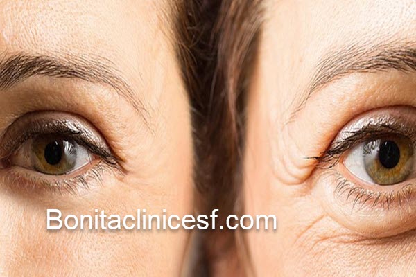 مرکز تخصص جراحی پف زیر چشم در اصفهان | کلینیک بنیتا اصفهان