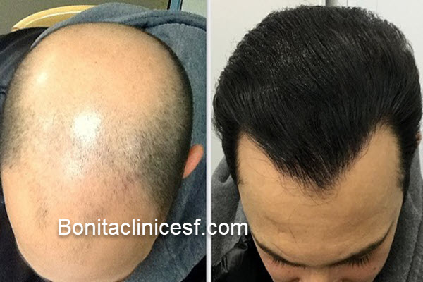 کاشت مو به روش میکروگرافت در اصفهان | کلینیک بنیتا اصفهان