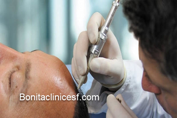 کاشت مو به روش میکروگرافت در اصفهان | کلینیک بنیتا اصفهان