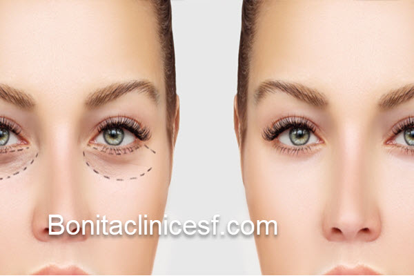 مرکز تخصص جراحی پف زیر چشم در اصفهان | کلینیک بنیتا اصفهان