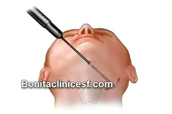 بهترین کلینیک ساکشن غبغب در اصفهان | کلینیک بنیتا اصفهان